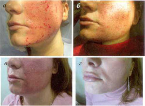 stages of skin restoration after fractional ablation procedure