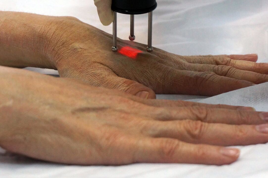 Laser hand rejuvenation with a non-ablative method